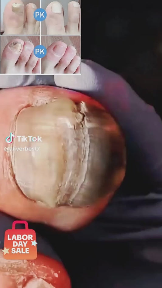 NailRevive™ – Tratament Intens pentru Unghii Deteriorate și Îngălbenite